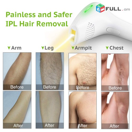 Epiliator Mazaheracman Lazer IPL Laser Hair Removal Lazerayin Epilyator Elos Epilyatr